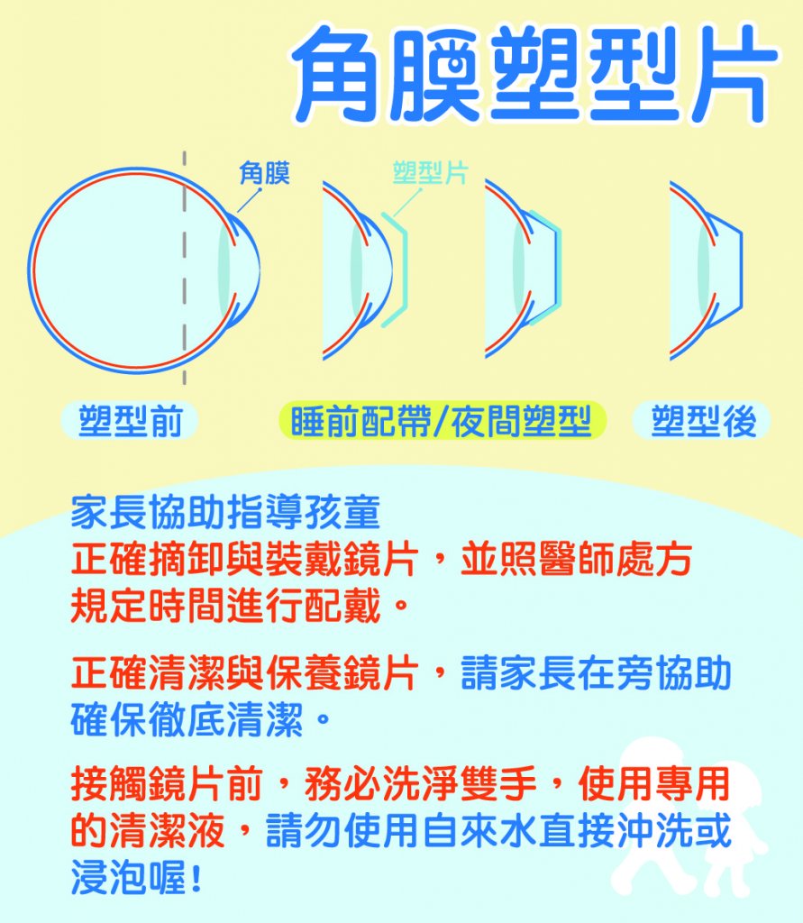 角膜塑型片是什麼？價格、後遺症、優缺點全解析